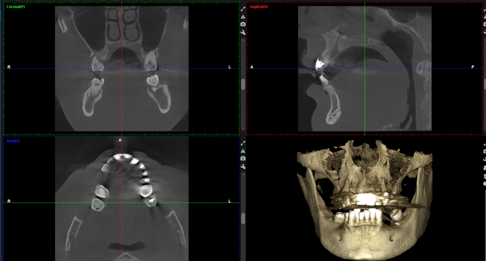 Advantages of digitally conducted implantology